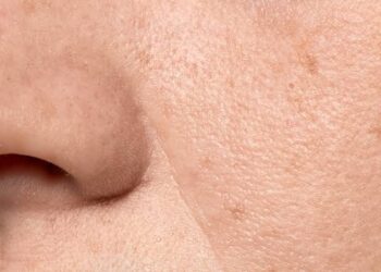 Kulit Kering Saat Puasa? Ini Cara Sederhana Untuk Mengatasinya