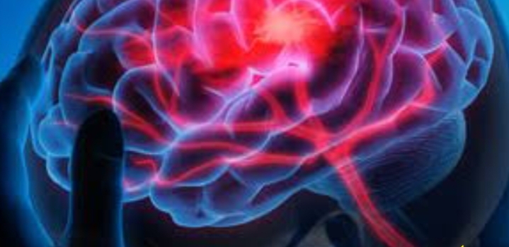 Hindari Stroke dengan 4 Kebiasaan Malam Ini