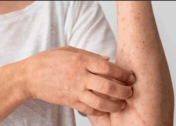 Waspada Gatal Kulit Tak Kunjung Sembuh