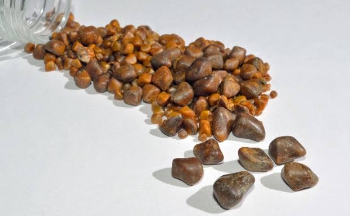 Batu Empedu dan Kanker Empedu: Benarkah Kaitan Ada?