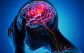 Risiko Stroke Dini 16% Lebih Tinggi pada Pemilik Golongan Darah A, Temuan Studi