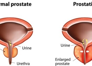 Tujuh Obat Herbal Ampuh Sembuhkan Prostat