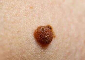 Waspadai Gejala Awal Kanker Kulit Deteksi Dini Selamatkan Nyawa