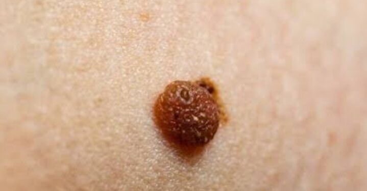 Waspadai Gejala Awal Kanker Kulit Deteksi Dini Selamatkan Nyawa