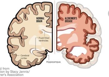 Studi Baru Ungkap Gaya Hidup yang Bisa Mengurangi Risiko Alzheimer