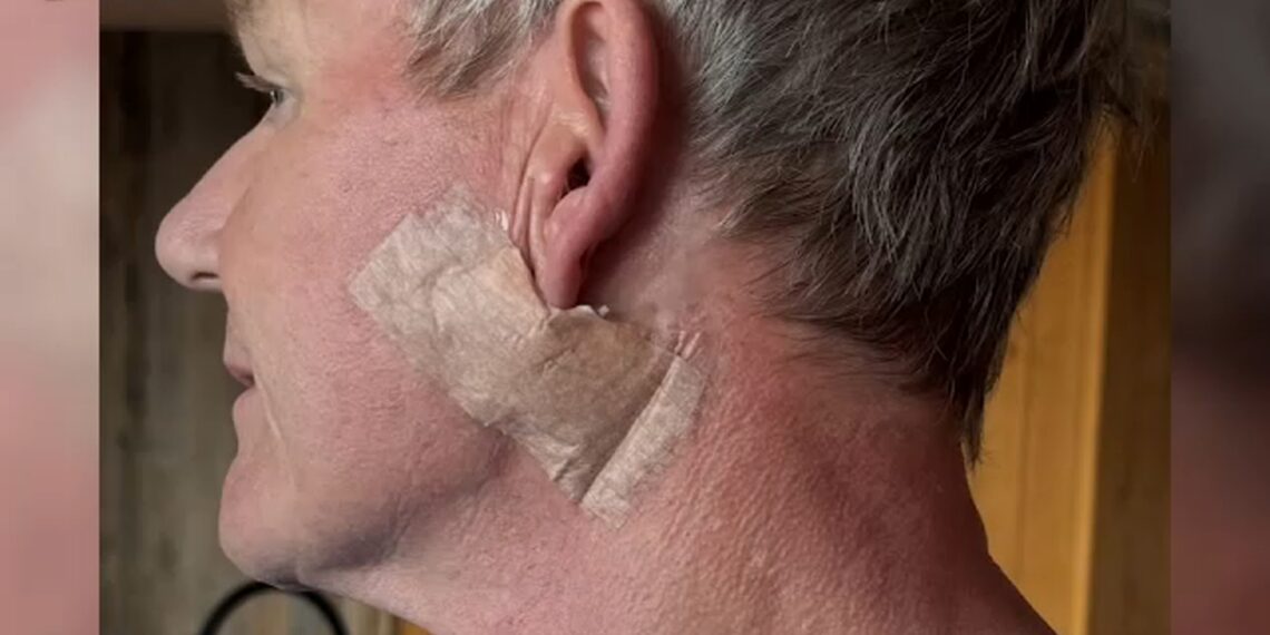 Operasi Kanker Kulit, Gordon Ramsay Ajak Publik Waspada