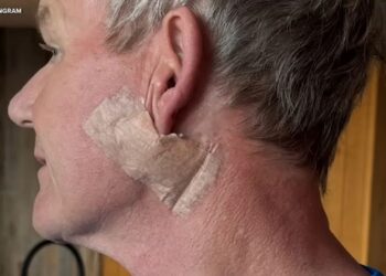 Operasi Kanker Kulit, Gordon Ramsay Ajak Publik Waspada